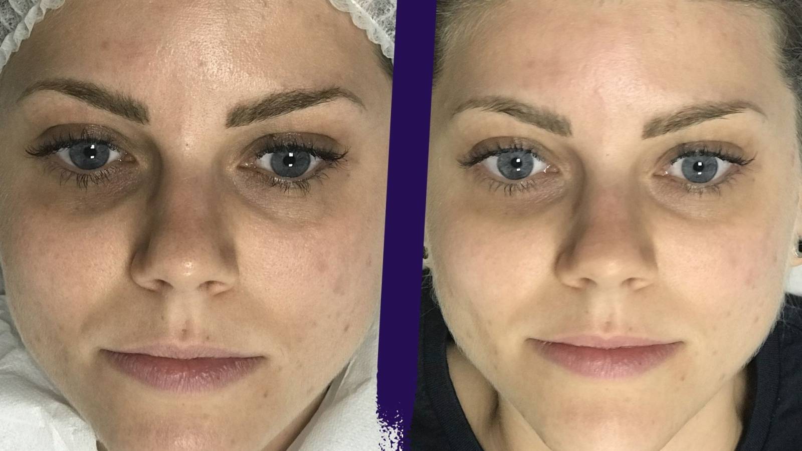 Effectuez un soin peau nette à Lyon