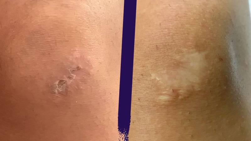 Camouflez vos cicatrices grâce à la dermographie réparatrice à Lyon