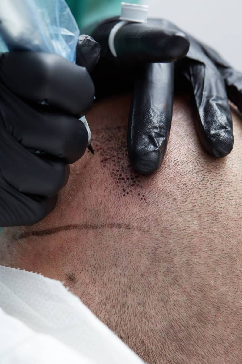 apprendre à pigmenter les cheveux avec la tricopigmentation à Lyon